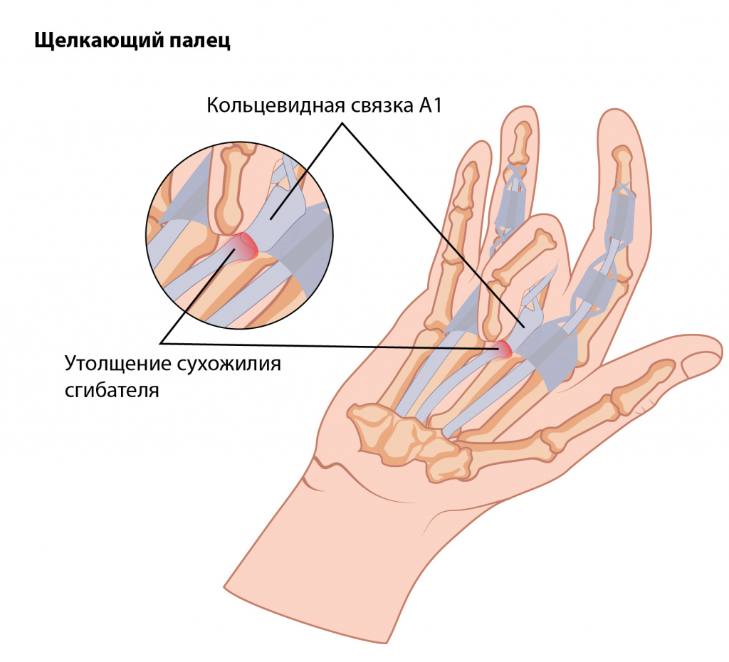 Синдром щелкающего пальца