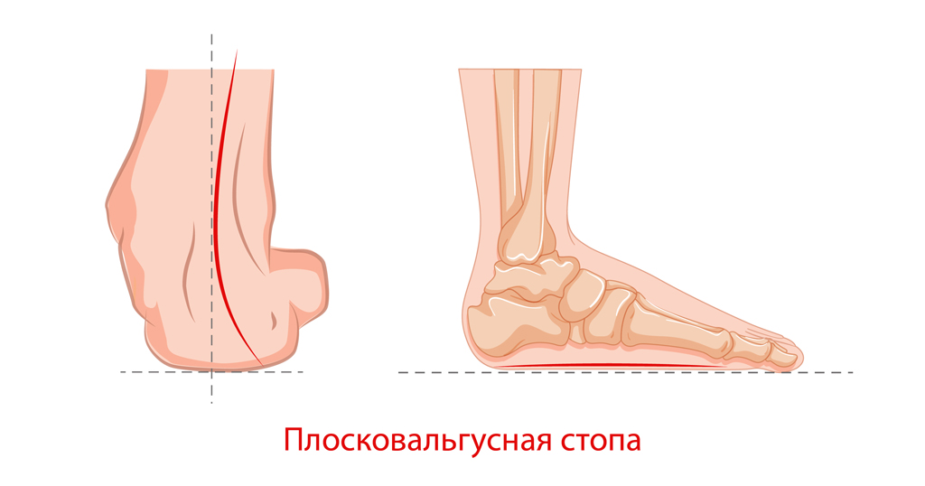 Вальгус стоп-02.jpg