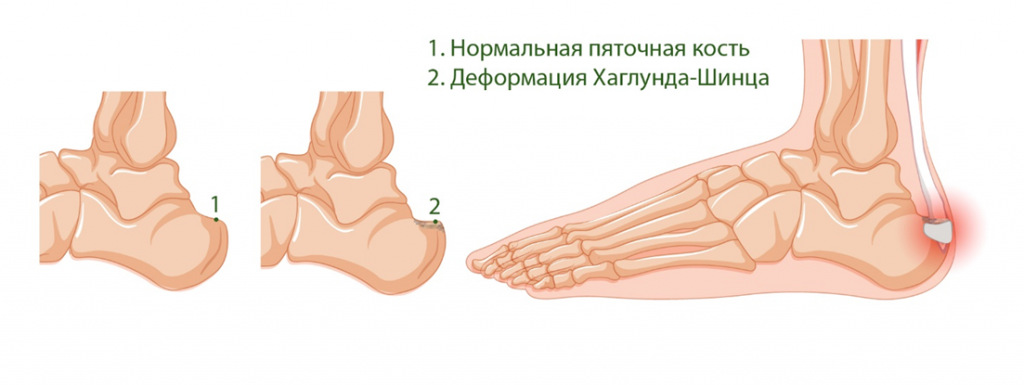 Норма и деформация пяточной кости