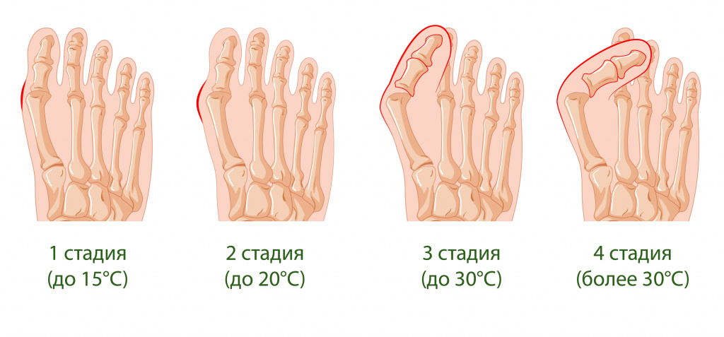 Степени вальгусной деформации