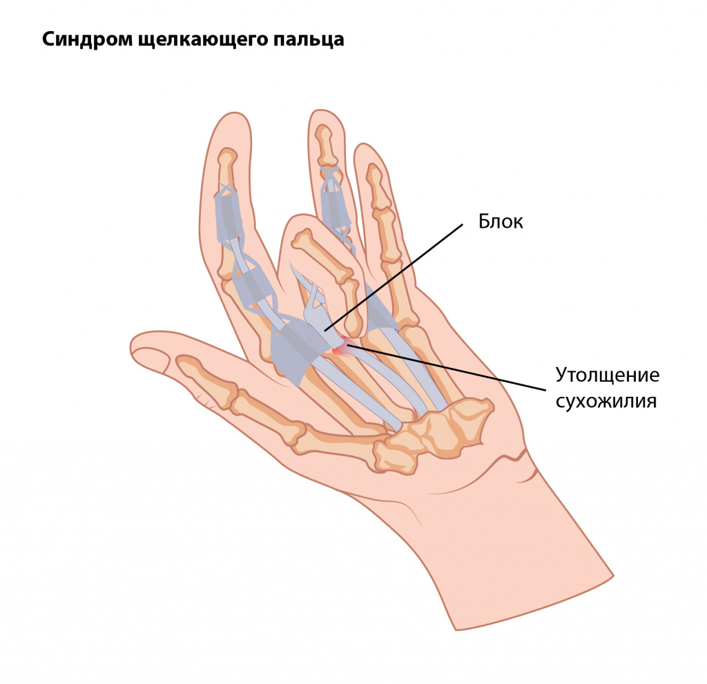 Причины синдрома щелкающего пальца