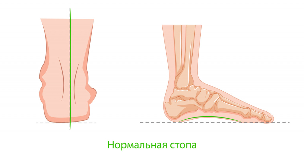 Вальгус стоп-03.jpg