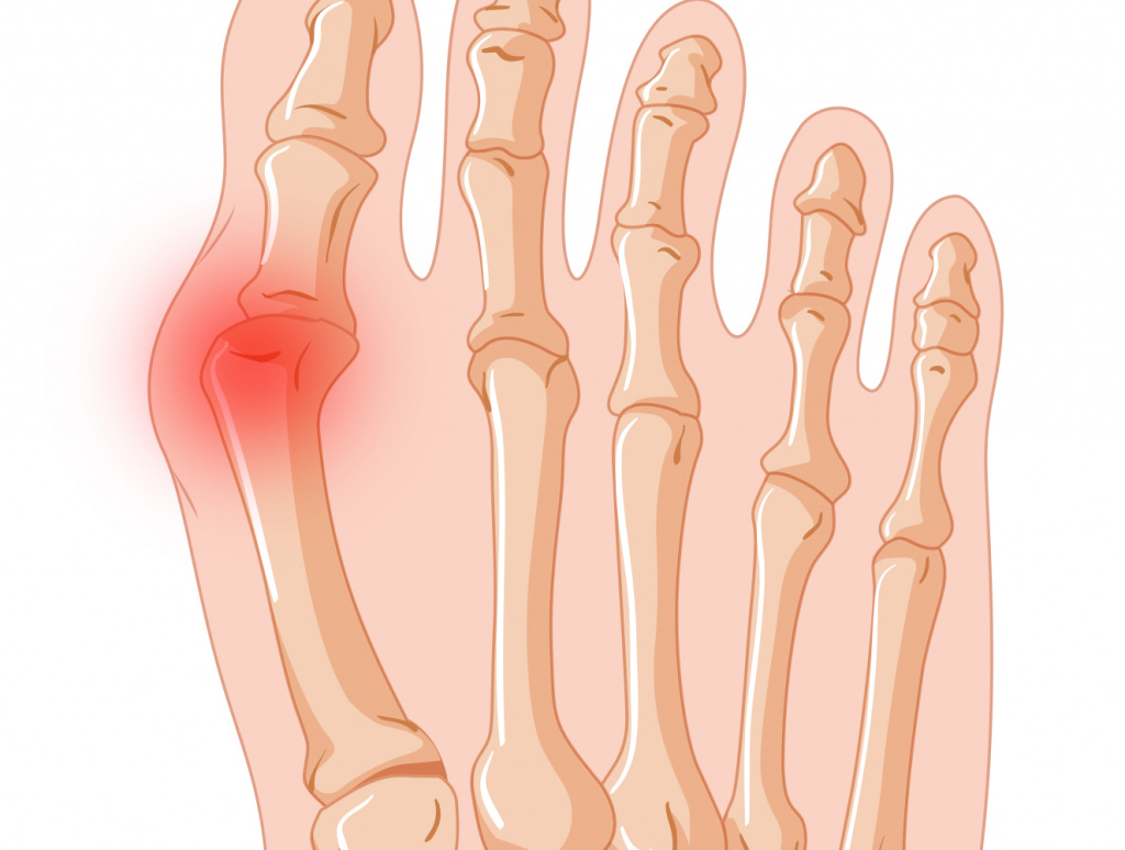 Вальгусная деформация первого пальца стопы (hallux valgus)