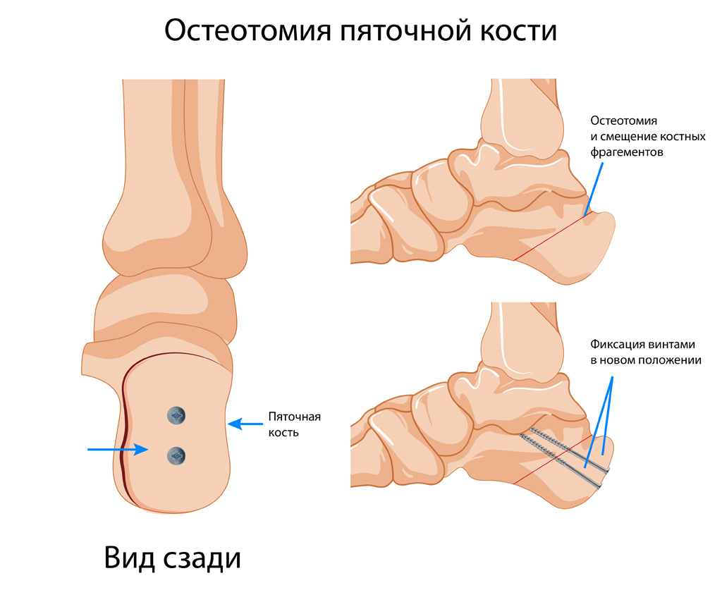 Вальгус стоп-05.jpg