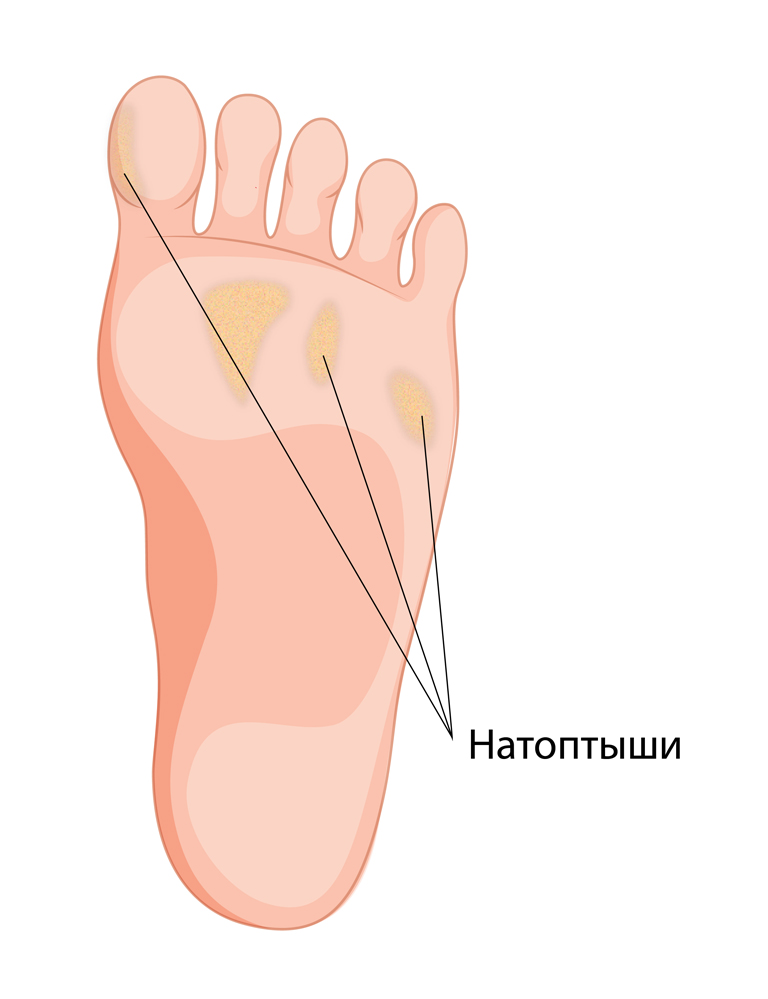 метатарзагия-03.jpg