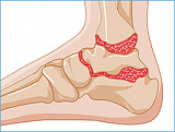 Артроз голеностопного и подтаранного суставов