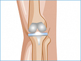 Эндопротезирование коленного сустава
