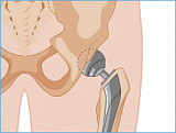 Эндопротезирование тазобедренного сустава