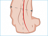 Плоско-вальгусная деформация стоп