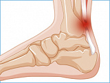 Разрыв Ахиллова сухожилия 